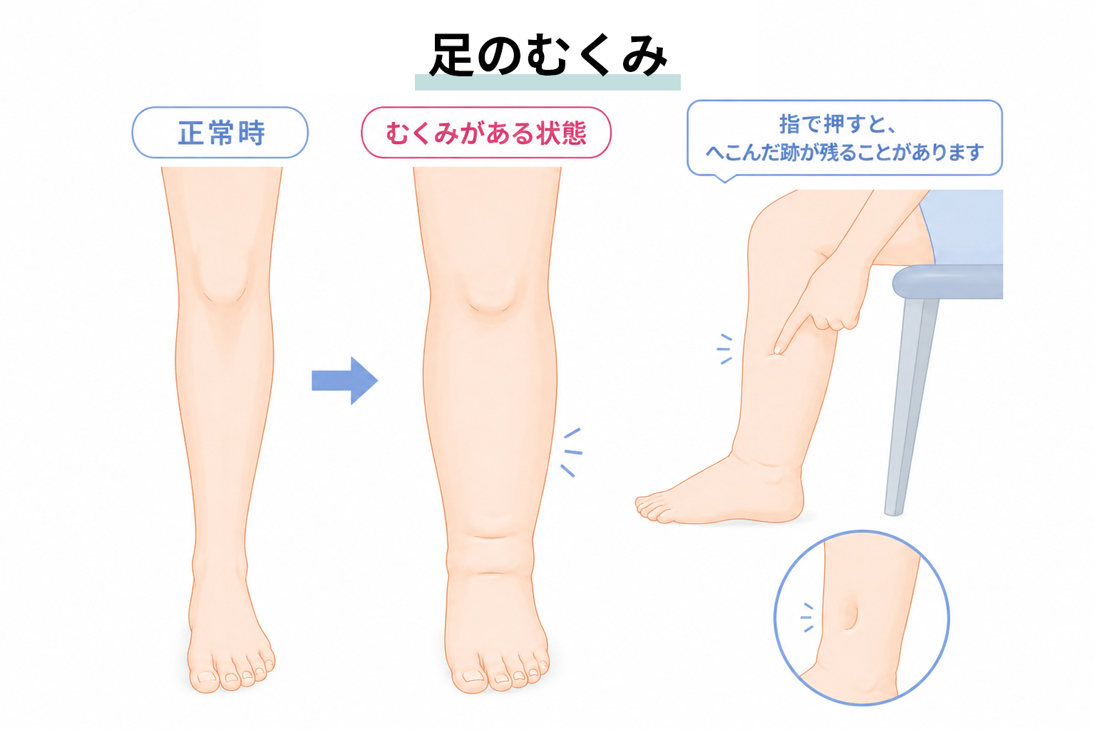 足のむくみ