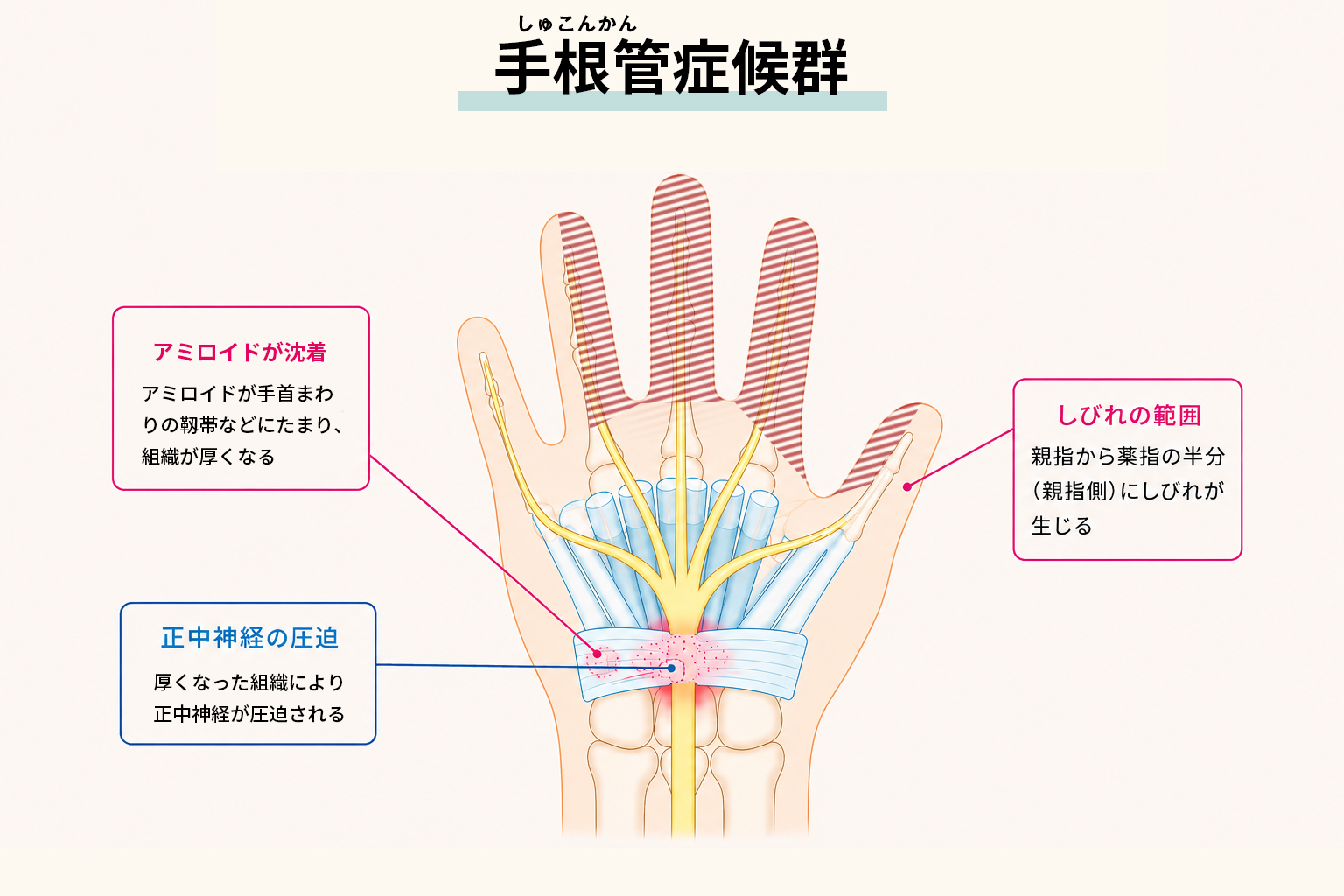手根管症候群の説明図