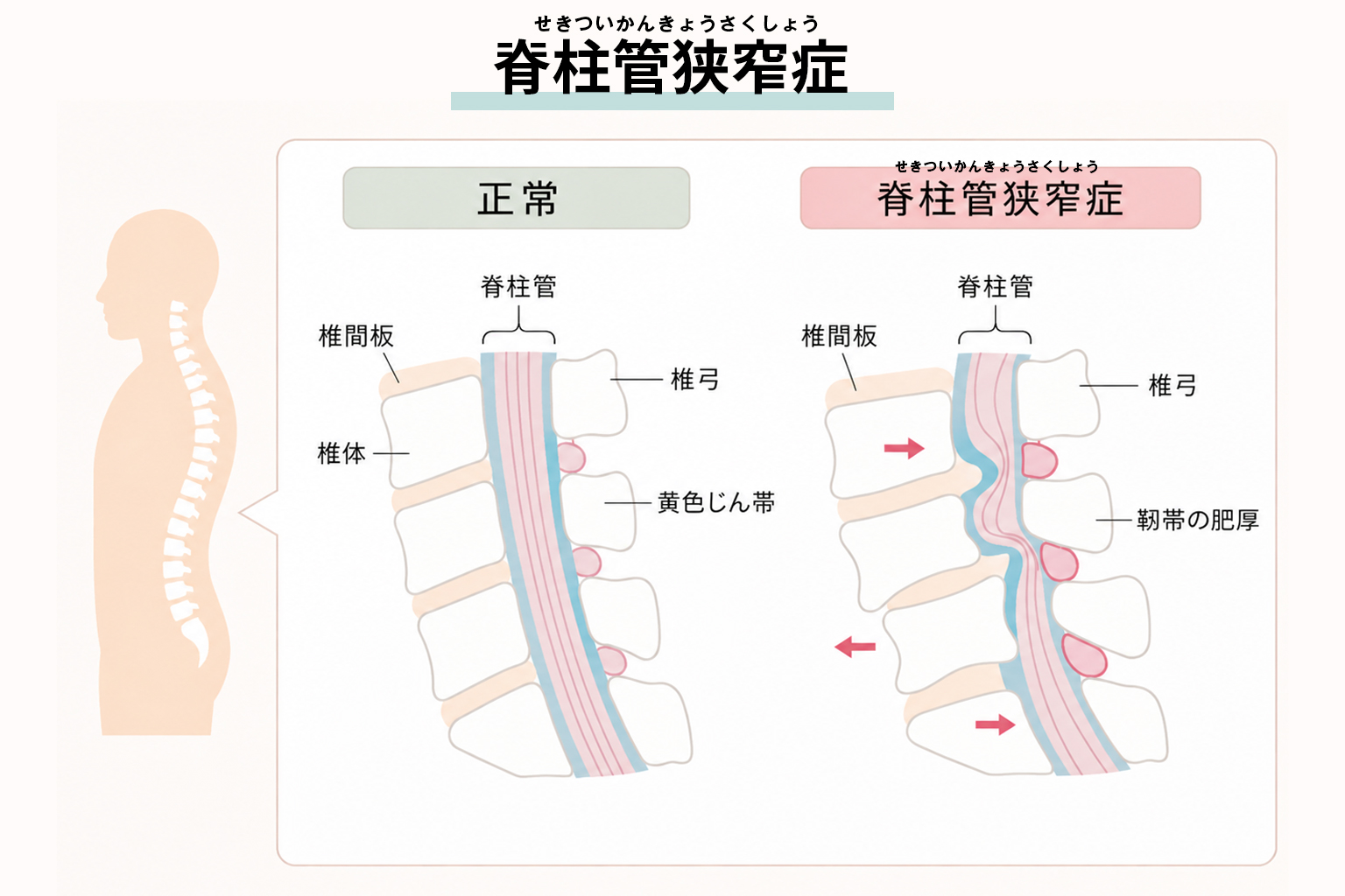 脊柱管狭窄症の説明図