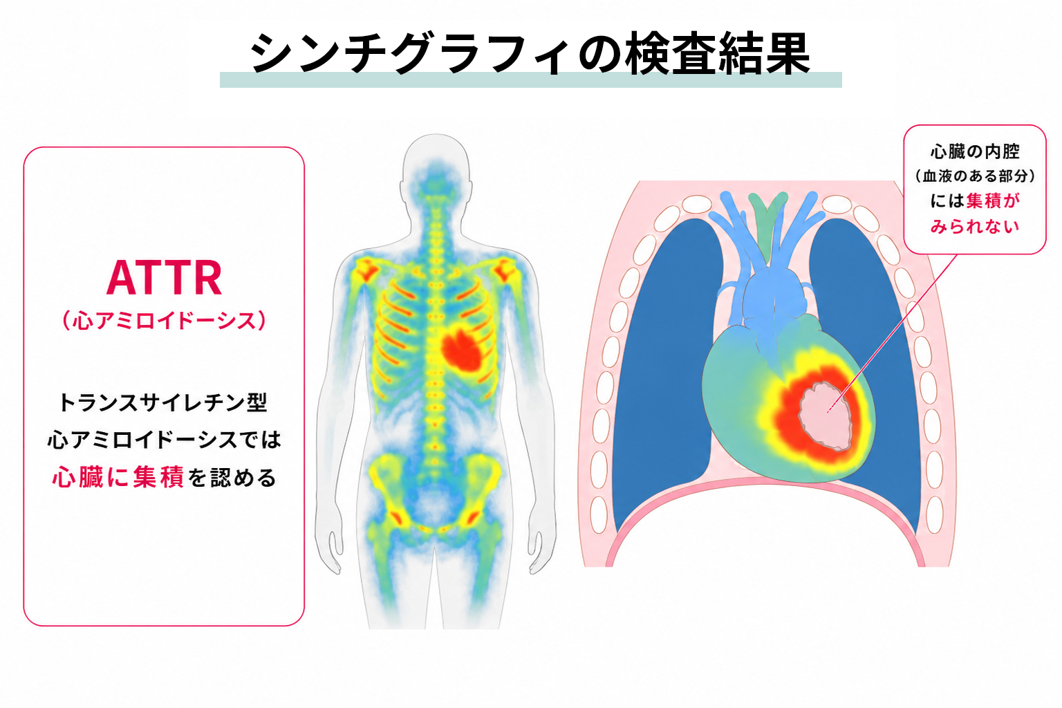 シンチグラフィの検査結果